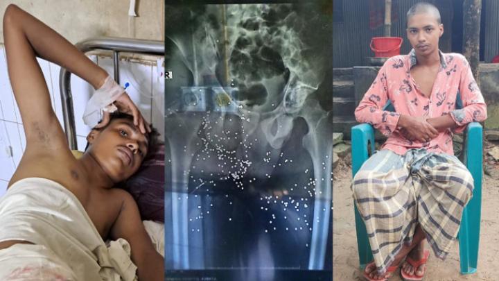২ শতাধিক স্প্লিন্টার শরীরে নিয়ে বিছানায় দিন কাটছে কুষ্টিয়ার সুমনের,কেউ খোঁজ নেয়নি